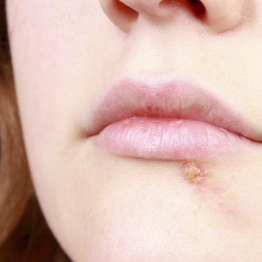 Schmerzhafte Papeln erscheinen